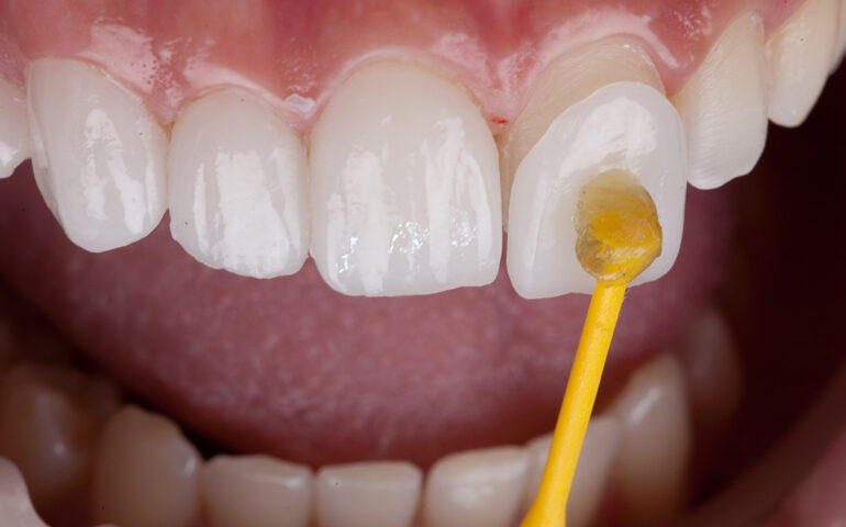 Dental Veneers in Ahmedabad