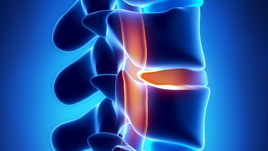 Spinal Cord Stimulator