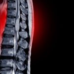 Understanding Spinal Stenosis