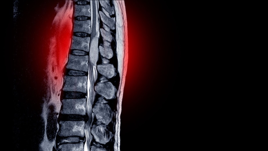 Understanding Spinal Stenosis