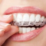What are the five significant benefits of Invisalign? 