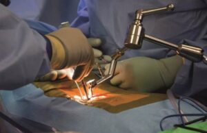 Dr. Larry Davidson Explores How AI Personalizes Spinal Implant Material Selection for Optimal